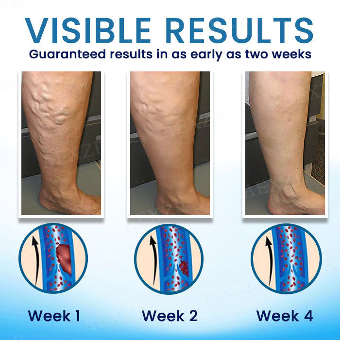 Cvreoz® Herbal Varicose Veins Treatment Spray - ✅Discount in limited time!