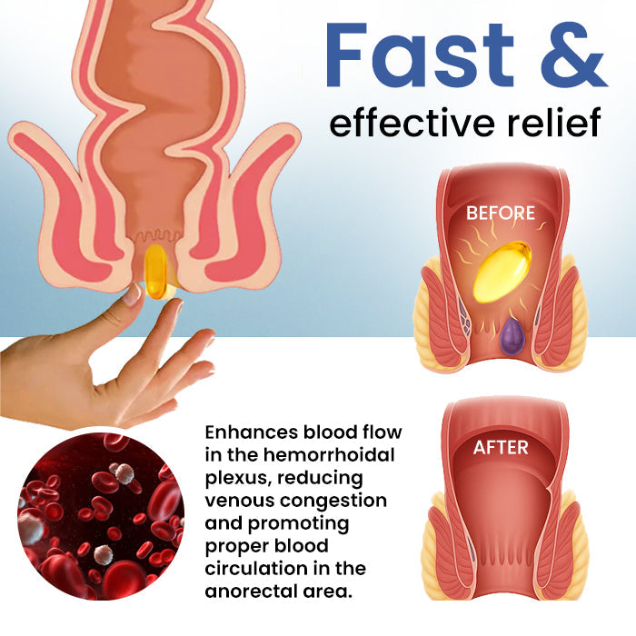 Official Store: Cvreoz® Natural Hemorrhoid Capsules - 7 Days to a Happy, Pain-Free 🍑—Guaranteed!