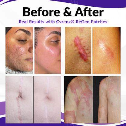 Cvreoz® ReGen Microneedles Pro Patches⭐Effective for: Various skin conditions including rashes, spots, papules, scars, keratosis, acne, sores, rashes, skin growths and warts