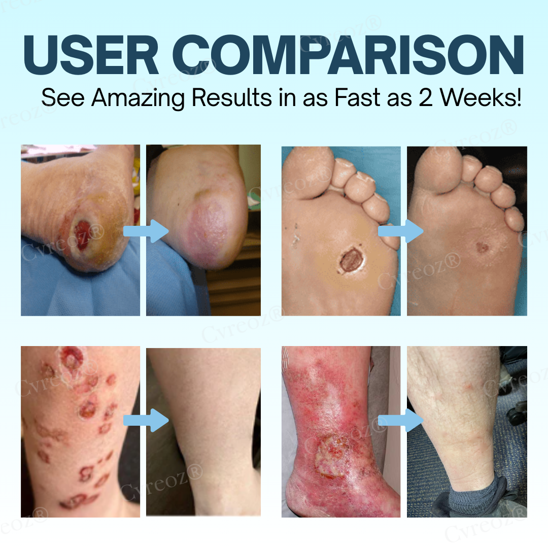 Official Store: Cvreoz® Diabetes Treatment Cream - Don't let a small wound cost you your foot—or your life！
