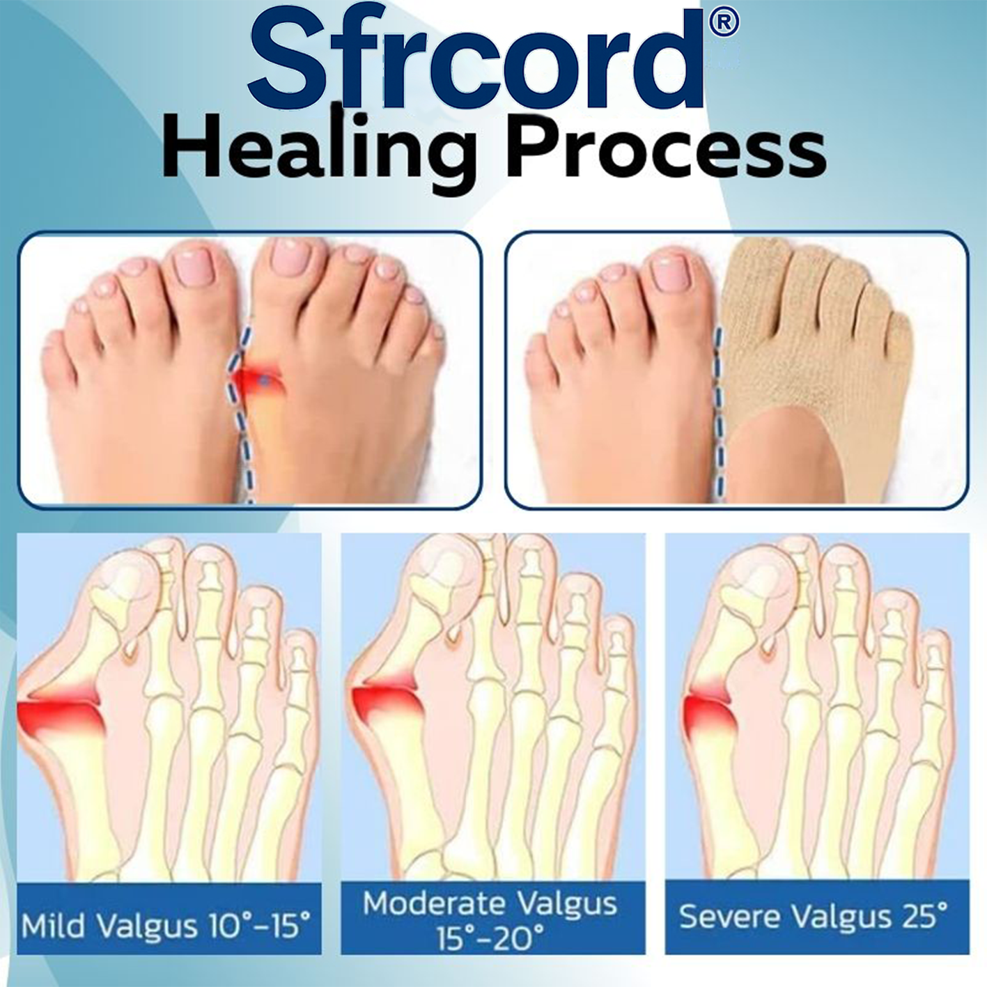 Sfrcord® Bunion Relief Socks - Non-Surgical Solution