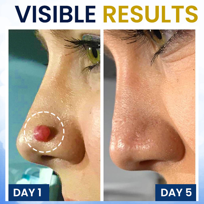 BLACK FRIDAY 40% OFF | AEXZR® Skin Tag Cryo Treatment Spray