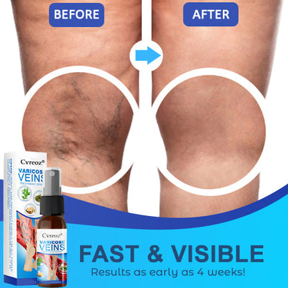Cvreoz® Varicose Veins Treatment Spray-✅ Clinically proven to eliminate varicose veins in just 7 days!