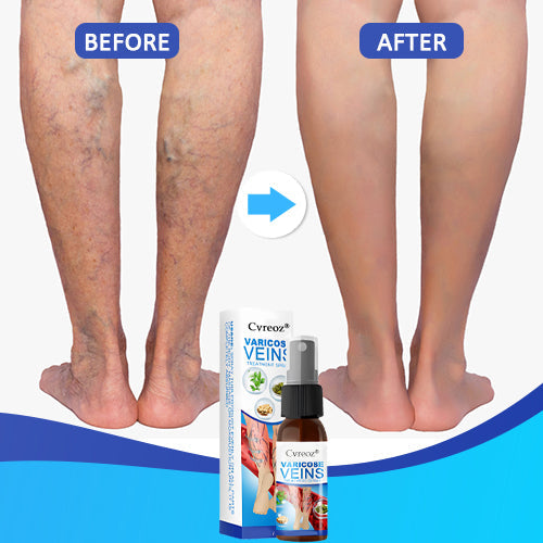 Cvreoz® Varicose Veins Treatment Spray-✅ Clinically proven to eliminate varicose veins in just 7 days!