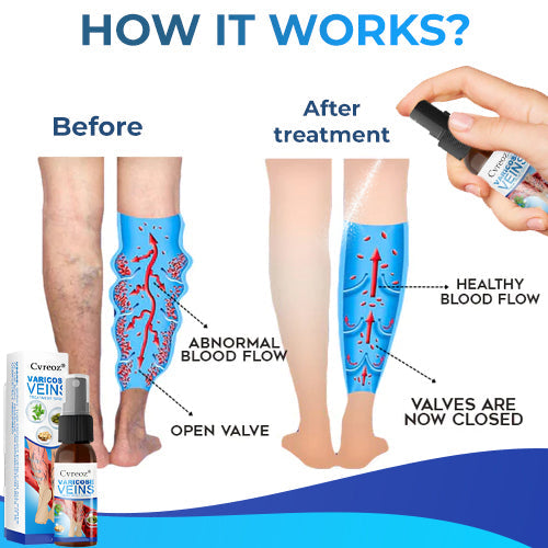 Cvreoz® Varicose Veins Treatment Spray-✅ Clinically proven to eliminate varicose veins in just 7 days!