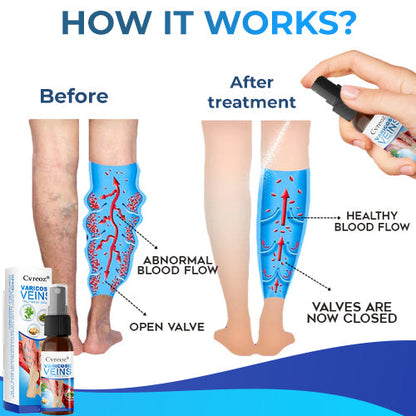 Cvreoz® Varicose Veins Treatment Spray-✅ Clinically proven to eliminate varicose veins in just 7 days!